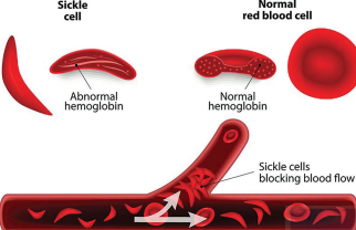 सिकल सेल एनीमिया