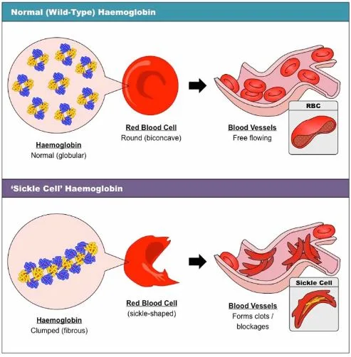 सिकल सेल एनीमिया(Sickle Cell Anemia)